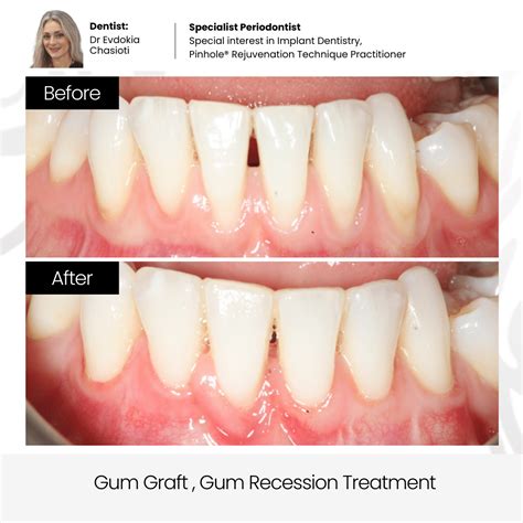 Gum Receding Treatment