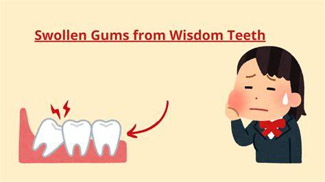 Gum Swelling Around Wisdom Teeth