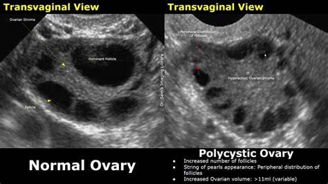 Gynecologist Polycystic Ovaries