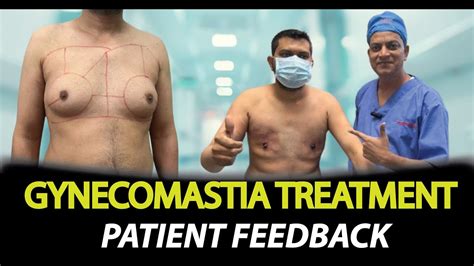 Gynecomastia Treatment Without Surgery