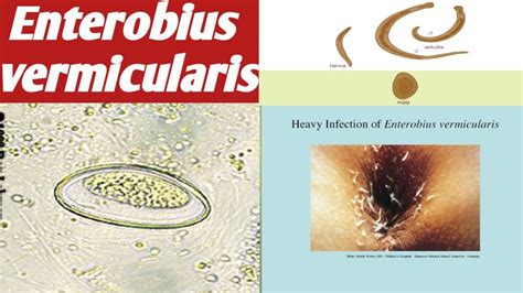 Habitat Of Enterobius Vermicularis