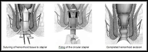 Haemorrhoid Operation Recovery