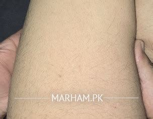 Hair Disappearing On Legs