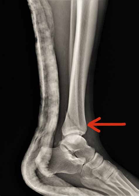 Hairline Fracture Of The Ankle