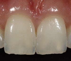 Hairline Fracture Tooth