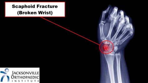 Hairline Fracture Wrist