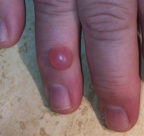 Hard Cyst On Finger