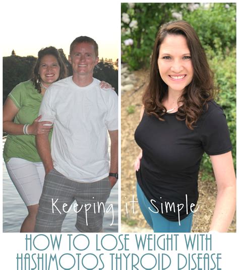 Hashimoto's Thyroiditis Weight Loss