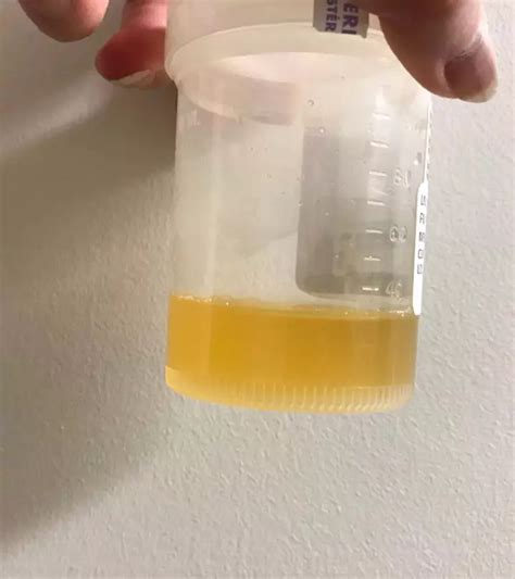 Hazy Urine During Pregnancy