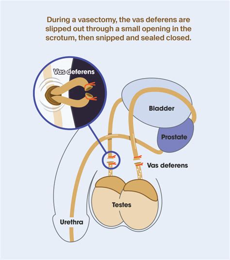 Heal Time For Vasectomy