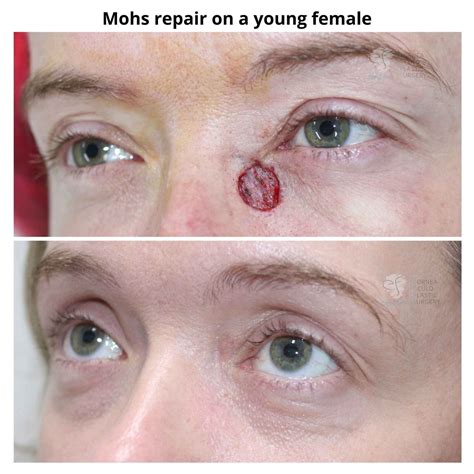 Healing After Mohs Surgery On Face