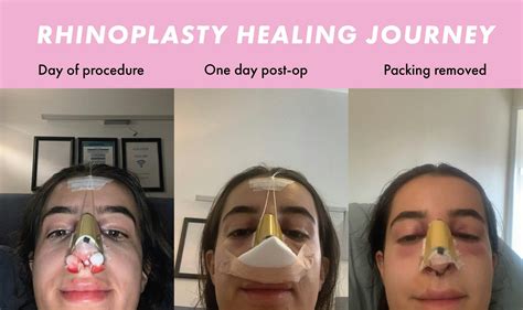 Healing Time Of Rhinoplasty