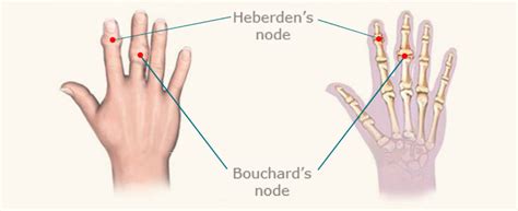 Heberden's Nodes And Bouchard's Nodes