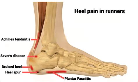 Heel Bone Pain
