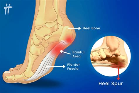 Heel Spur Pain
