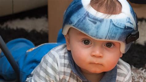 Helmet Shaping Infant Head