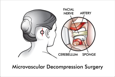 Hemifacial Spasm Treatment