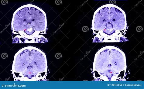 Hemorrhage In Pons