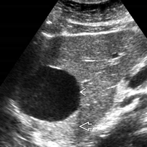 Hepatic Cyst Ultrasound