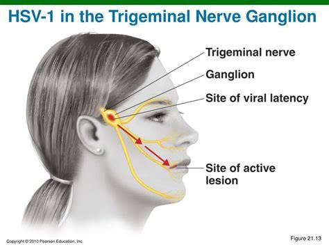 Herpes In Ganglion Photo