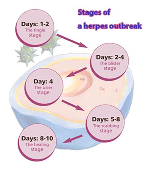 Herpes Outbreak Stages