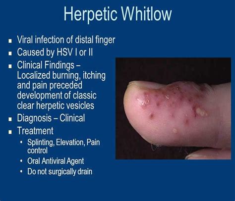 Herpes Whitlow Virus