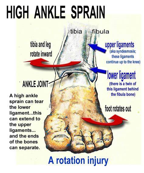 High Ankle Sprain Symptoms