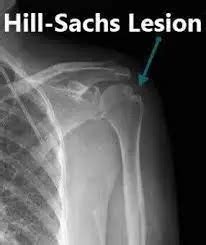 Hill Sachs Disease