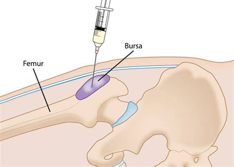 Hip Bursa Injection