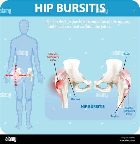 Hip Bursitis Management