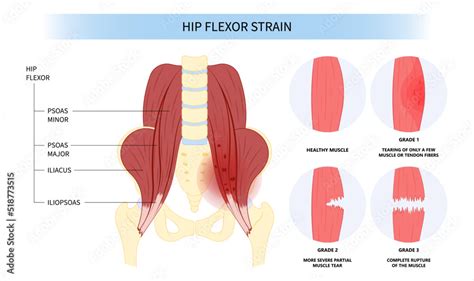 Hip Flexor Tear