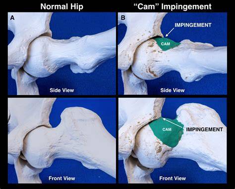 Hip Impingement Treatment