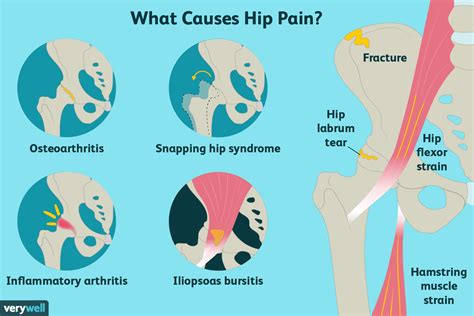 Hip Problems Bursitis
