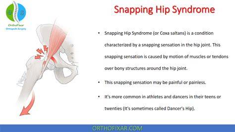 Hip Snapping Syndrome