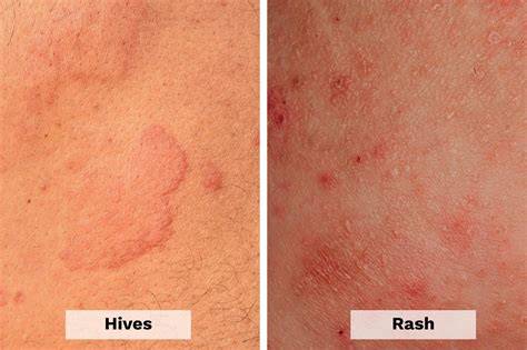 Hives Vs Rash