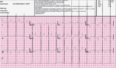 Hocm Ekg