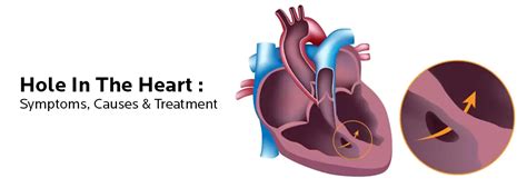 Hole In Heart Signs