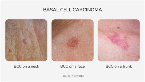 How Common Is Basal Cell Carcinoma