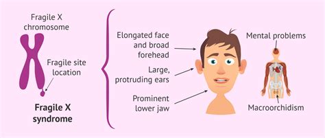 How Common Is Fragile X Syndrome