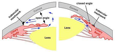 How Common Is Narrow Angles In Eyes
