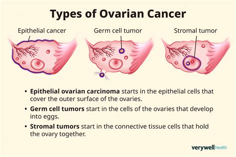 How Common Is Ovarian Cancer