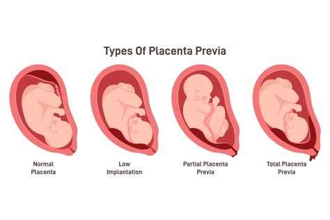 How Common Is Placenta Previa