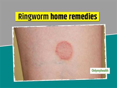 How Common Is Ringworm