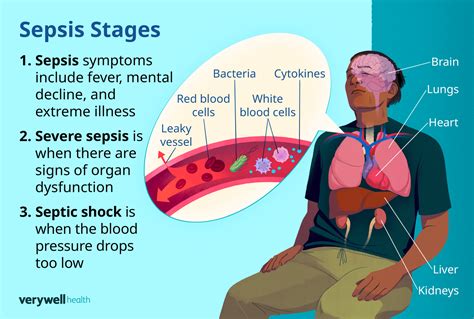 How Common Is Sepsis