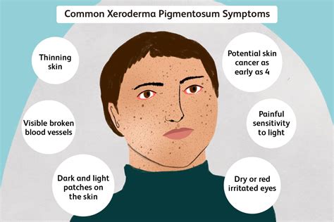 How Common Is Xeroderma Pigmentosum