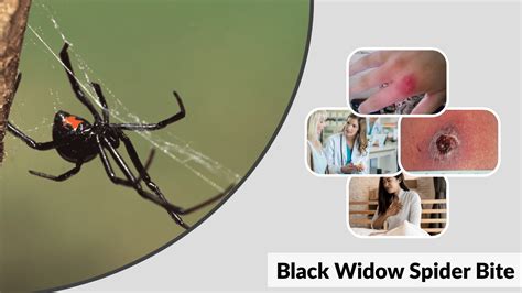 How Dangerous Is A Black Widow Bite