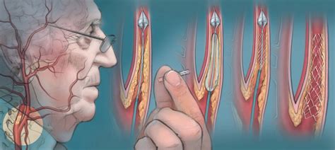 How Dangerous Is A Carotid Artery Stent