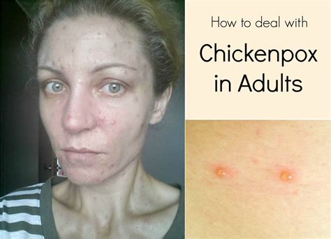 How Dangerous Is Chicken Pox For Adults