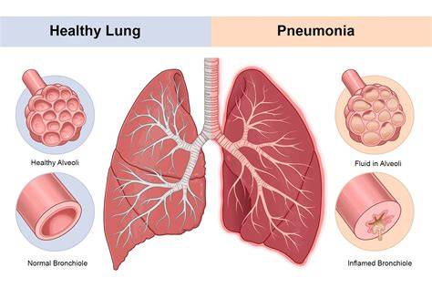 How Dangerous Is Pneumonia