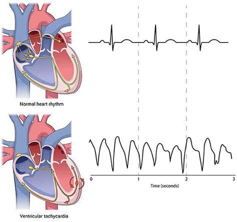 How Dangerous Is Ventricular Tachycardia